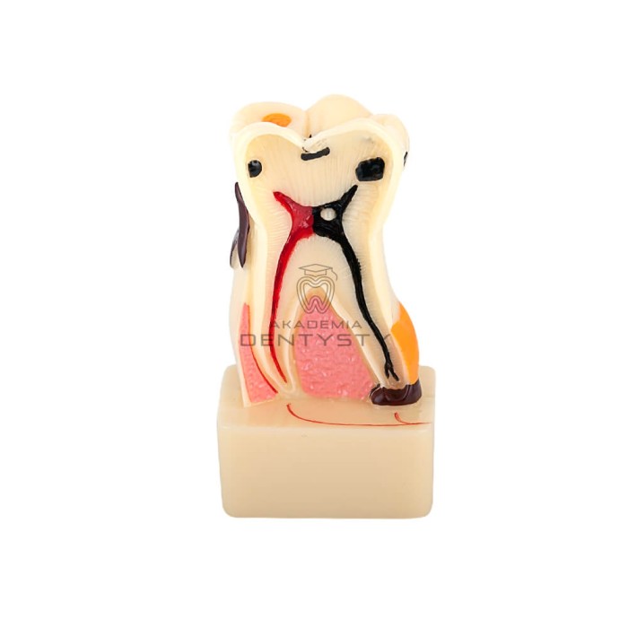 Model zęba człowieka PERIO-01