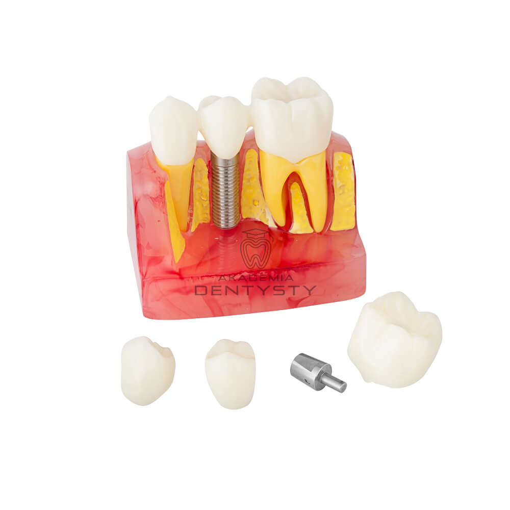 Model - implant, korony oraz most protetyczny CSK-027