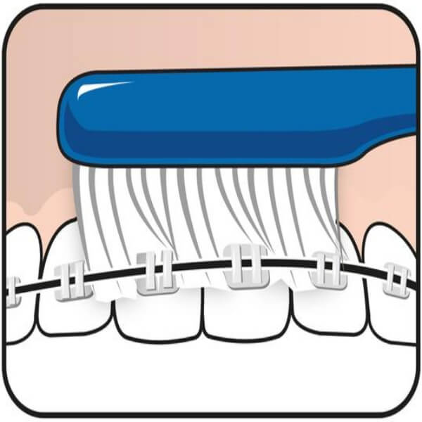 TEPE IMPLANT/ORTHO - szczoteczka ortodontyczna BLISTER