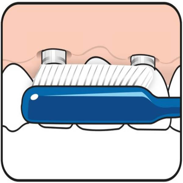 TEPE IMPLANT/ORTHO - szczoteczka ortodontyczna BLISTER